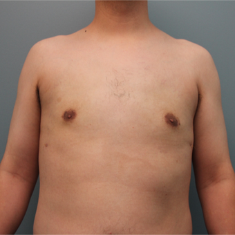 This 20 something year old man was treated with Liposuction to remove gynecomastia after 3467029