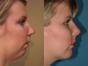 Chin Augmentation after 409094