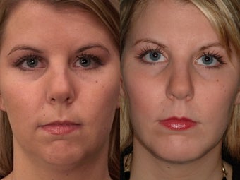 Chin Augmentation before 409094
