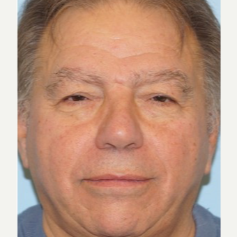 55-64 year old man treated with Ptosis Surgery before 3727871