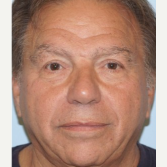 55-64 year old man treated with Ptosis Surgery after 3727871