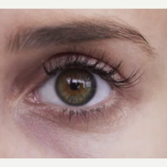 25-34 year old woman treated with Restylane before 3499317