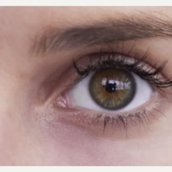 25-34 year old woman treated with Restylane after 3499317