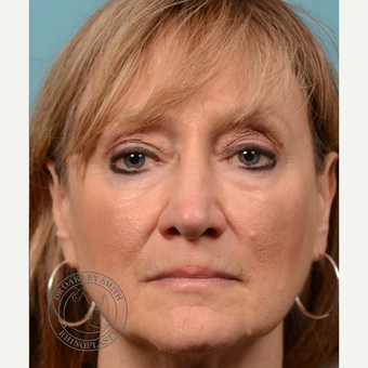 35-44 year old woman treated with septoplasty/revision rhinoplasty after 3313213