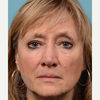 35-44 year old woman treated with septoplasty/revision rhinoplasty before 3313213