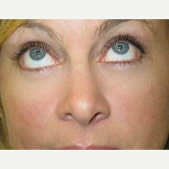38 year old patient treated for correction of eye bags 1968106