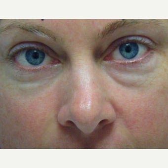 38 year old patient treated for correction of eye bags before 1968106