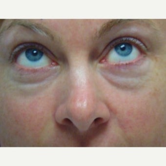 38 year old patient treated for correction of eye bags 1968106