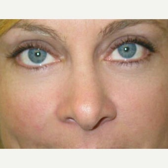 38 year old patient treated for correction of eye bags after 1968106