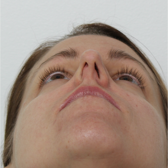 35-44 year old woman treated with Septoplasty before 3605559