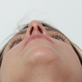35-44 year old woman treated with Septoplasty after 3605559