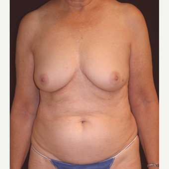72 y/o - Immediate Left DIEP Breast Flap Reconstruction before 3842799