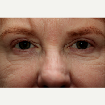 55-64 year old woman treated with Chemical Peel before 3646160