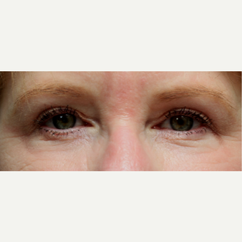 55-64 year old woman treated with Chemical Peel after 3646160