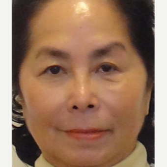 65-74 year old woman treated with Radiesse after 3710905