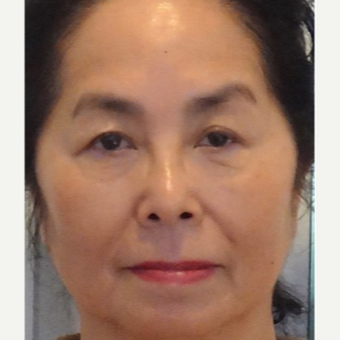 65-74 year old woman treated with Radiesse before 3710905