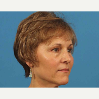 55-64 year old woman treated with Upper Eyelid Surgery after 3787479