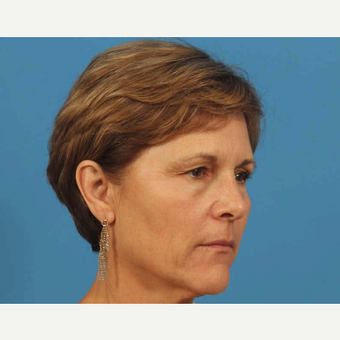 55-64 year old woman treated with Upper Eyelid Surgery before 3787479