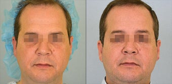 Endoscopic Brow Lift before 1217066