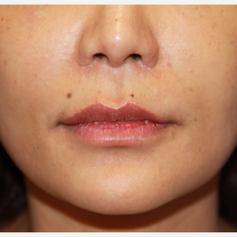 35-44 year old woman treated with Lip Augmentation before 3578320