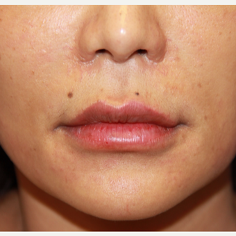 35-44 year old woman treated with Lip Augmentation after 3578320