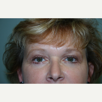 Upper and Lower Eyelid Surgery 2 Months Post-op after 3032902