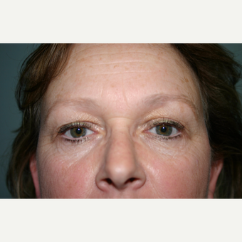 Upper and Lower Eyelid Surgery 2 Months Post-op before 3032902