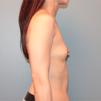 45 years old first Breast Augmentation before 3389757