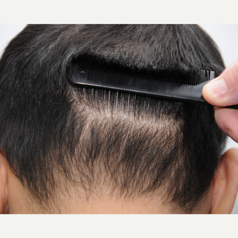 25-34 year old man treated with ARTAS Robotic Hair Transplant after 3697191
