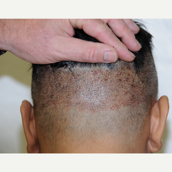 25-34 year old man treated with ARTAS Robotic Hair Transplant before 3697191