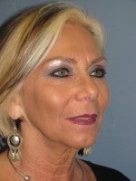 55-64 year old woman treated with Neck Lift before 3103923