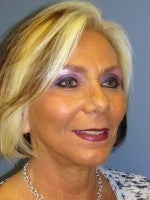 55-64 year old woman treated with Neck Lift after 3103923