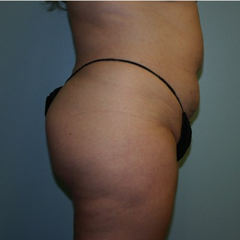 Brazilian Butt Lift after 3667610