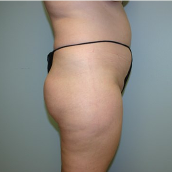 Brazilian Butt Lift before 3667610