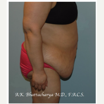 45-54 year old woman treated with Tummy Tuck before 3609940