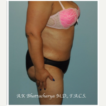 45-54 year old woman treated with Tummy Tuck after 3609940