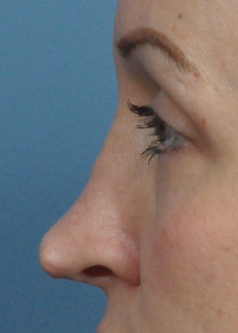 Patient treated with Rhinoplasty before 1223138