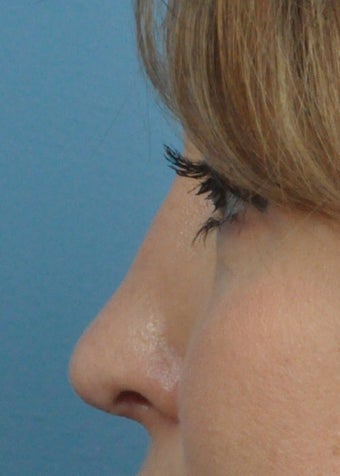 Patient treated with Rhinoplasty after 1223138