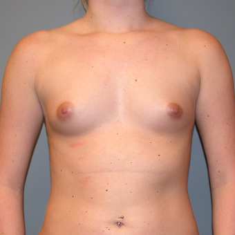 25-34 year old woman treated with Breast Augmentation before 3455302