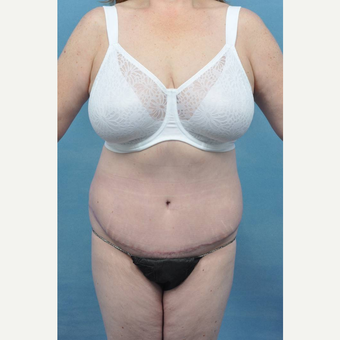45-54 year old woman treated with Tummy Tuck after 3489505