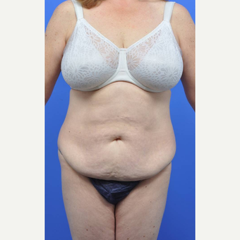 45-54 year old woman treated with Tummy Tuck before 3489505