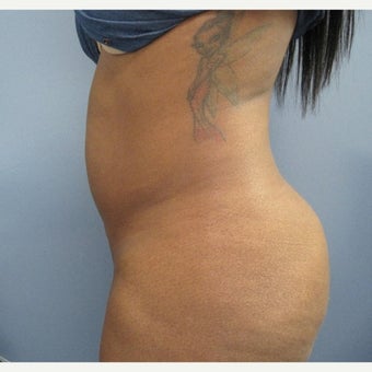 25-34 year old woman treated with Fat Transfer before 1683089
