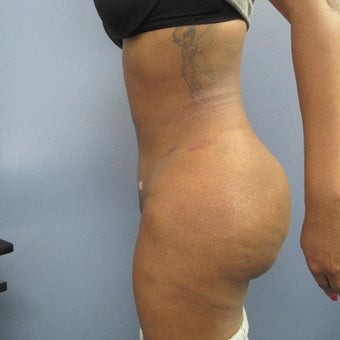25-34 year old woman treated with Fat Transfer after 1683089