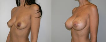 Breast Augmentation with Saline breast implants under the muscle 520cc before 1064835