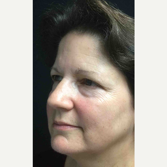 55-64 year old woman treated with Eyelid Surgery before 3218637