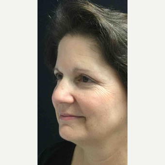 55-64 year old woman treated with Eyelid Surgery after 3218637