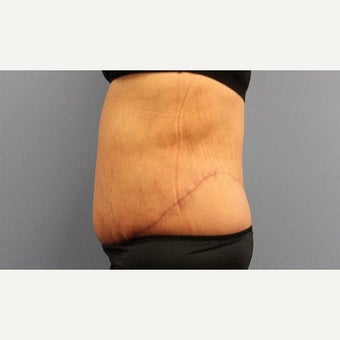55-64 year old woman treated with Body Lift after 2010042