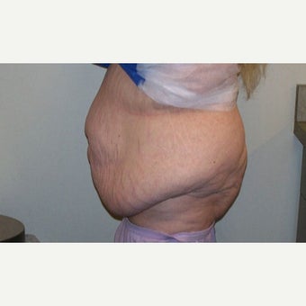 55-64 year old woman treated with Body Lift before 2010042