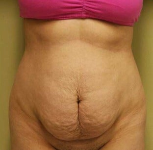 25-34 year old woman treated with Tummy Tuck before 3207502