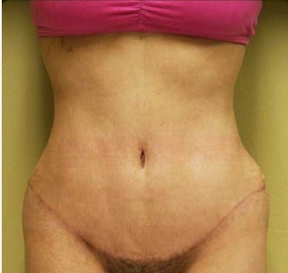 25-34 year old woman treated with Tummy Tuck after 3207502